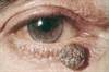 Melanoma Melanoma