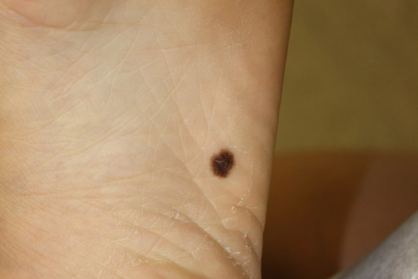 Black Spot On Sole Of Foot Under Skin