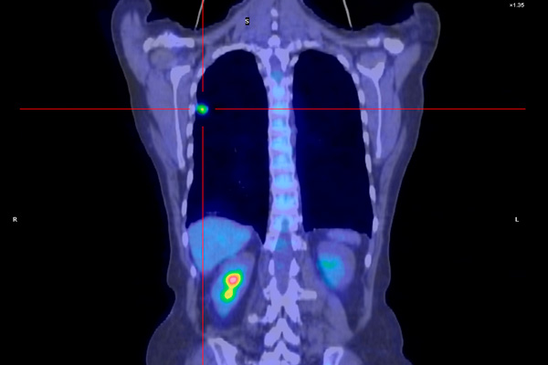 lung-cancer