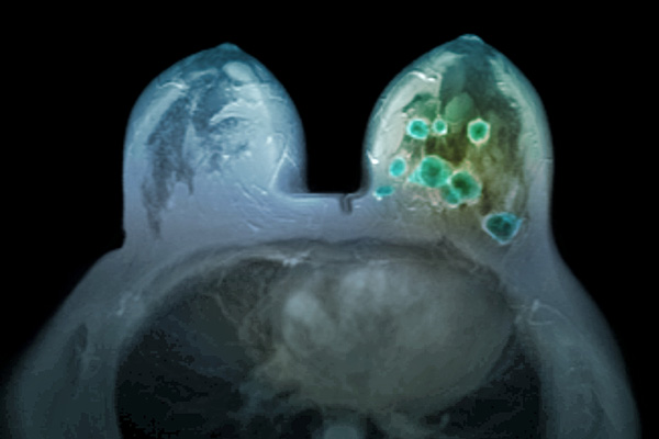 Breakthrough Therapy Designation >> Tumor Type Linked to Invasive Recurrence Risk in HER2+ Breast Cancer - Cancer Therapy Advisor Breakthrough Therapy Designation >> Tumor Type Linked to Invasive Recurrence Risk in HER2+ Breast Cancer - Cancer Therapy Advisor