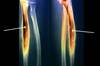 Ewing Sarcoma Ewing Sarcoma