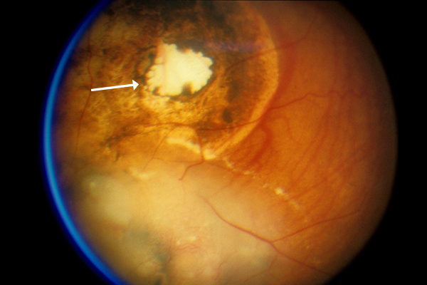 Retinoblastoma