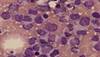 A 47-Year-Old Woman with Pancytopenia After Treatment with Radioiodine Therapy A 47-Year-Old Woman with Pancytopenia After Treatment with Radioiodine Therapy
