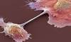 Pancreatic Cancer Pancreatic Cancer