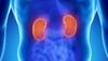 Sequence of Sunitinib and Nephrectomy May Not Affect Progression-free Rate in mRCC Sequence of Sunitinib and Nephrectomy May Not Affect Progression-free Rate in mRCC