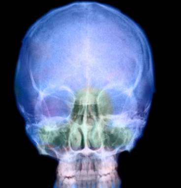 Proton Therapy May Have Benefit in Treating Advanced Head and Neck Cancers Proton Therapy May Have Benefit in Treating Advanced Head and Neck Cancers