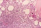 MRD Complete Response Induced by Blinatumomab Associated With Improved Survival MRD Complete Response Induced by Blinatumomab Associated With Improved Survival