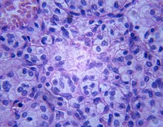 Larger Renal Cell Carcinoma Tumors Predict High-Grade Pathology - Cancer Therapy Advisor