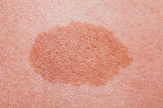 Itchy Rash on Back - Causes, Symptoms, Treatment