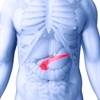 Phase 2 Trial of Apatorsen for Metastatic Pancreatic Cancer Misses Primary Endpoint Phase 2 Trial of Apatorsen for Metastatic Pancreatic Cancer Misses Primary Endpoint
