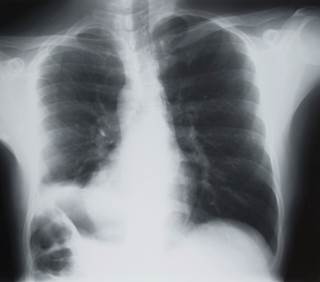 For patients with non-solid lung nodules, annual computed tomography (CT) scans may be all that's needed to monitor their condition
