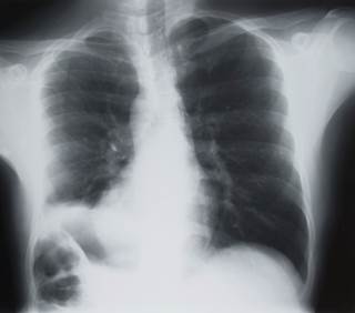 For patients with non-solid lung nodules, annual computed tomography (CT) scans may be all that's needed to monitor their condition For patients with non-solid lung nodules, annual computed tomography (CT) scans may be all that's needed to monitor their condition