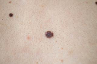 very itchy red blotchy rash on torso, legs arms, back, and ...