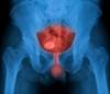 Clinicians Address Barriers to Progress for Bladder Cancer Clinicians Address Barriers to Progress for Bladder Cancer