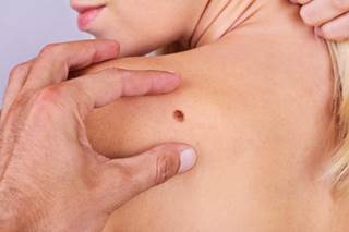 Melanoma treatment has improved dramatically in the past decade, and new advancements are already on the horizon. Melanoma treatment has improved dramatically in the past decade, and new advancements are already on the horizon.