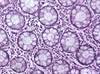 Managing Gastrinomas: Evaluating Treatment Options Managing Gastrinomas: Evaluating Treatment Options
