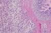 Gastric Linitis Plastica Diagnosis Uses Endoscopic and Radiologic Studies Approach Gastric Linitis Plastica Diagnosis Uses Endoscopic and Radiologic Studies Approach