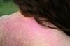 Dermatomyositis and Cancer Risk Dermatomyositis and Cancer Risk