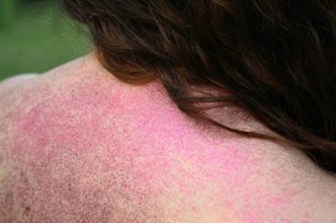 Dermatomyositis and Cancer Risk Dermatomyositis and Cancer Risk