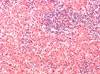 Selecting A TKI for Chronic Myeloid Leukemia Selecting A TKI for Chronic Myeloid Leukemia