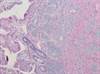 Telotristat for Diarrhea in Patients With Carcinoid Syndrome Telotristat for Diarrhea in Patients With Carcinoid Syndrome