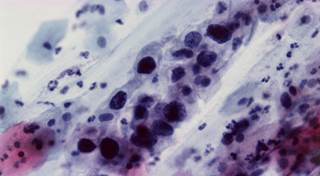 Age-Specific Cervical Cancer Rates Higher After Correction for Hysterectomy Age-Specific Cervical Cancer Rates Higher After Correction for Hysterectomy