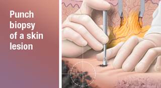 Vemurafenib for Melanoma and Other Cancers Vemurafenib for Melanoma and Other Cancers