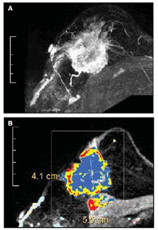 In high-risk women undergoing MRI screening, those with background parenchymal enhancement more likely to develop breast cancer. In high-risk women undergoing MRI screening, those with background parenchymal enhancement more likely to develop breast cancer.