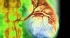 Tivozanib Offers Superior Outcomes in Refractory Metastatic Renal Cell Carcinoma Tivozanib Offers Superior Outcomes in Refractory Metastatic Renal Cell Carcinoma