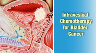Intravesical Chemotherapy for High-Risk Non-Muscle-Invasive Bladder Cancer Refractory to BCG Intravesical Chemotherapy for High-Risk Non-Muscle-Invasive Bladder Cancer Refractory to BCG