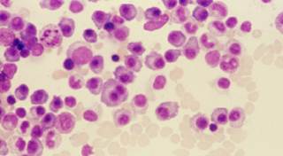 Two studies compare therapies for patients 65 and younger, those ineligible for stem-cell transplant. Two studies compare therapies for patients 65 and younger, those ineligible for stem-cell transplant.