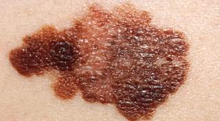 Risk for Melanoma Increased with IBD Risk for Melanoma Increased with IBD