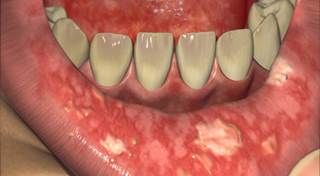 Resultado de imagen de MUCOSITIS