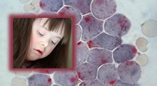 Leukemia Risk in Down Syndrome Patients Leukemia Risk in Down Syndrome Patients
