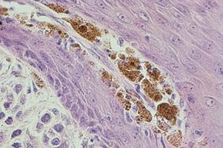 Researchers say testing patients for adverse reaction from some metal implants may be needed. Researchers say testing patients for adverse reaction from some metal implants may be needed.