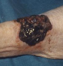 Dabrafenib, Trametinib Decrease Death Risk in Metastatic Melanoma Dabrafenib, Trametinib Decrease Death Risk in Metastatic Melanoma