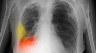 NSCLC Highly Represented at ASCO 2012: A review article with commentary from Dr. Mark A. Socinski NSCLC Highly Represented at ASCO 2012: A review article with commentary from Dr. Mark A. Socinski
