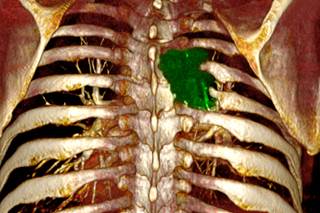 Conventional Chemo Better for Some Advanced NSCLC Conventional Chemo Better for Some Advanced NSCLC