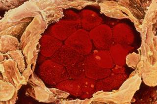 Figitumumab Not Safe or Effective for Advanced Non-Adenocarcinoma Non-Small Cell Lung Cancer (NSCLC) Figitumumab Not Safe or Effective for Advanced Non-Adenocarcinoma Non-Small Cell Lung Cancer (NSCLC)