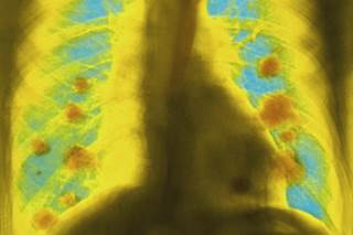 Doctors who know guidelines more likely to order low-dose computed tomography. Doctors who know guidelines more likely to order low-dose computed tomography.