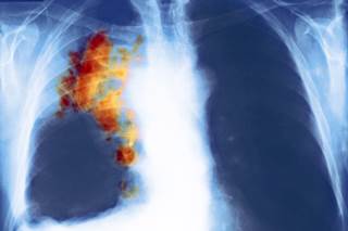 Afatinib + Paclitaxel Effective in EGFR Inhibitor-resistant Lung Cancer Afatinib + Paclitaxel Effective in EGFR Inhibitor-resistant Lung Cancer