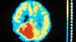 Successful First Step for Vaccine Targeting Brain Cancer Mutation Successful First Step for Vaccine Targeting Brain Cancer Mutation