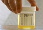 Urine Test for Cervical Human Papillomavirus (HPV) Proves Accurate Urine Test for Cervical Human Papillomavirus (HPV) Proves Accurate