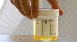 A Review of New Microhematuria Guidelines from the American Urological Association A Review of New Microhematuria Guidelines from the American Urological Association
