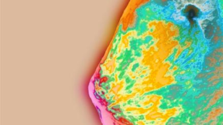 Post-Mastectomy Radiation Beneficial in Patients With 1 to 3 Nodes Post-Mastectomy Radiation Beneficial in Patients With 1 to 3 Nodes
