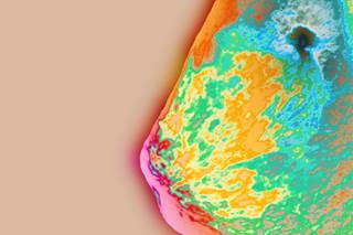 Cryoablation Promising for Early Invasive Breast Cancer Cryoablation Promising for Early Invasive Breast Cancer