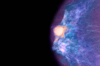 Fertility Drug May Not Increase Breast Cancer Risk Fertility Drug May Not Increase Breast Cancer Risk