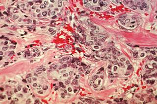 Vitamin D May Improve Breast Cancer Survival Vitamin D May Improve Breast Cancer Survival