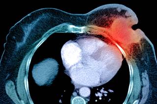 Exemestane + Ovarian Function Suppression Reduces Recurrence Risk in HR-Positive Early Breast Cancer Exemestane + Ovarian Function Suppression Reduces Recurrence Risk in HR-Positive Early Breast Cancer