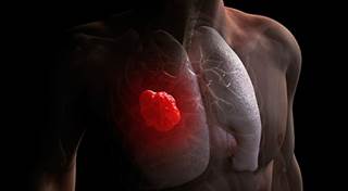 Role of Biologics in the Treatment of Lung Cancer Role of Biologics in the Treatment of Lung Cancer